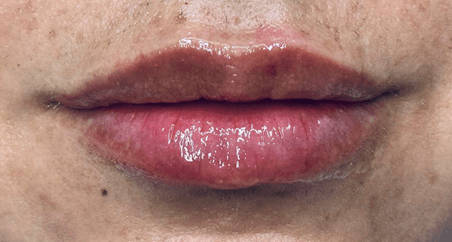 Lip Fillers - After