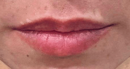 Lip Fillers - Before
