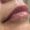 Lip Fillers - After