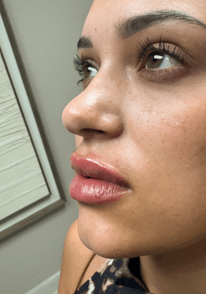 Lip Fillers - Before