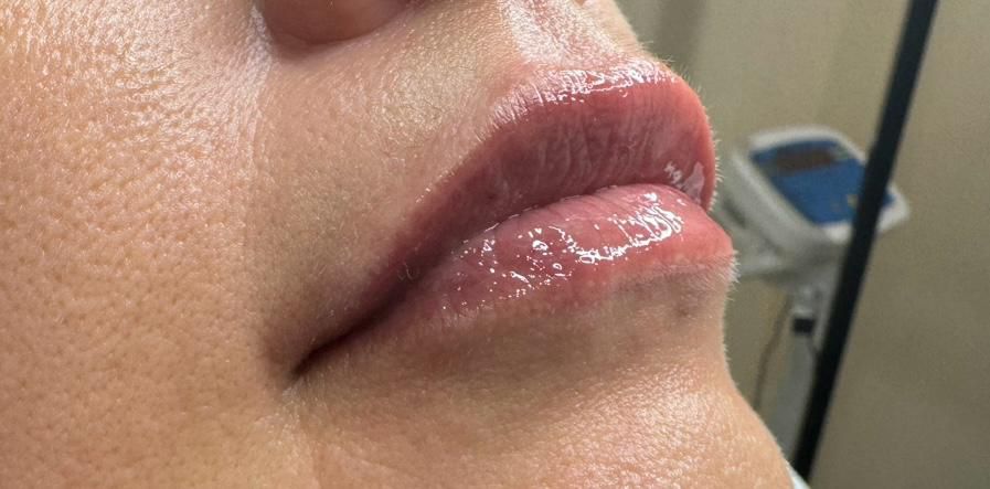 Lip Fillers - After
