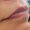 Lip Fillers - Before