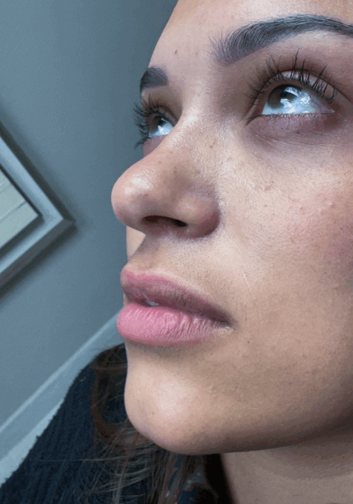 Lip Fillers - Before