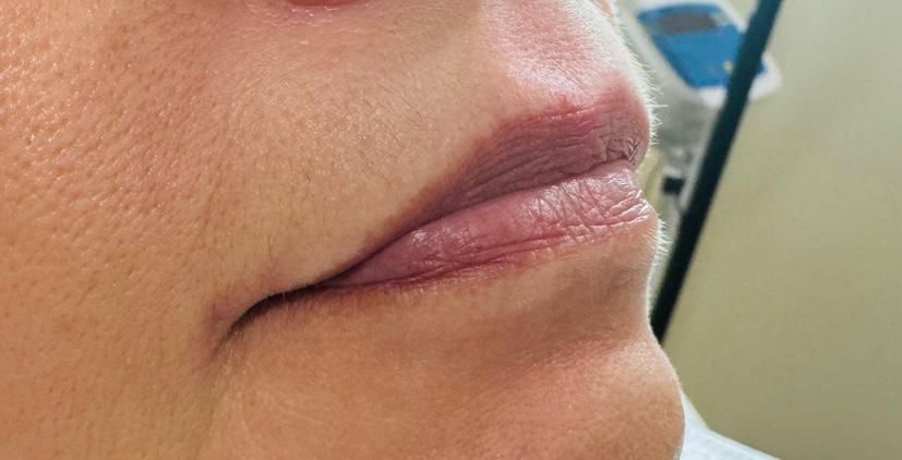 Lip Fillers - Before