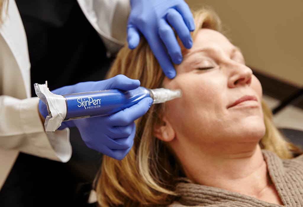 Microneedling Treatment at Cure Aesthetics Clinic