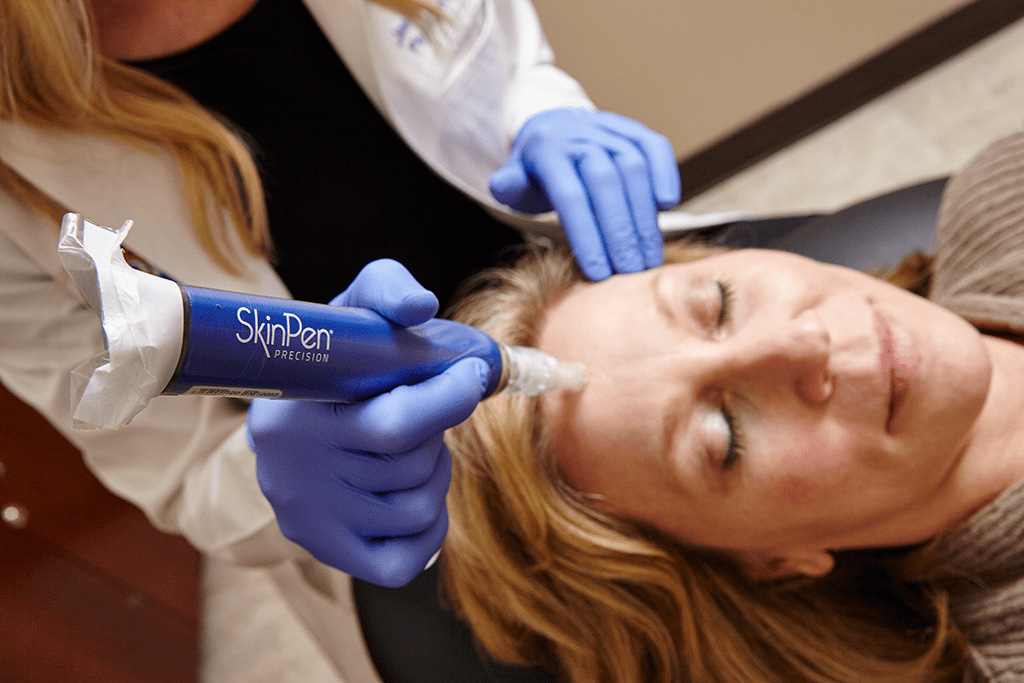 SkinPen Microneedling Treatment at Cure Aesthetics Clinic